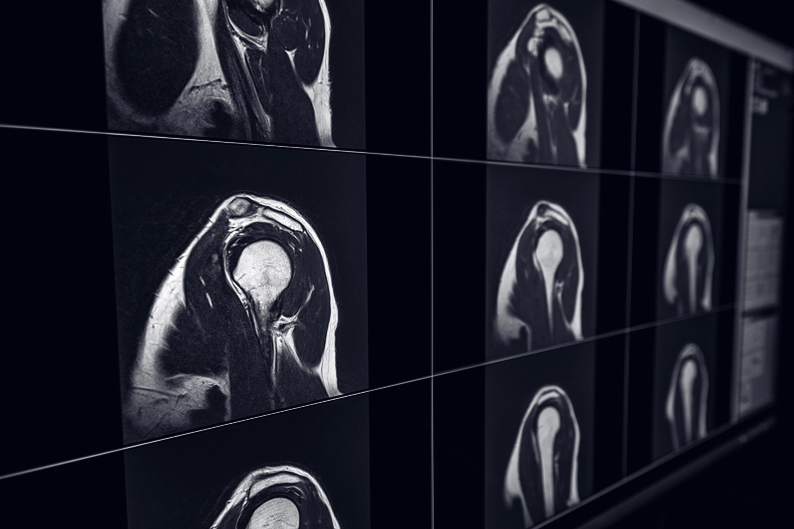 Image of MRI scans of the shoulder. 
